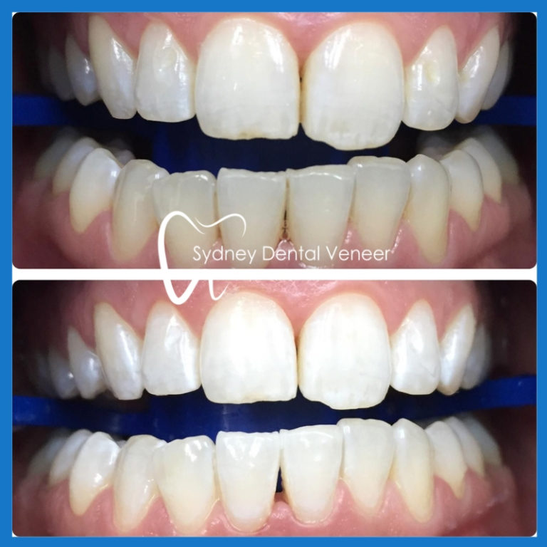 Best dentist for teeth whitening in Sydney