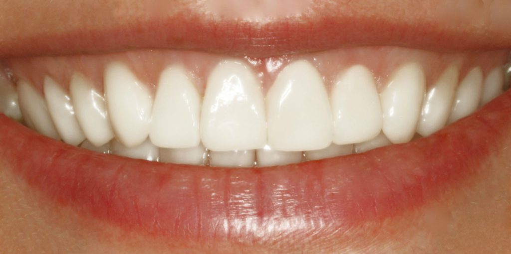 We are the best dental veneers dentistry in Sydney.