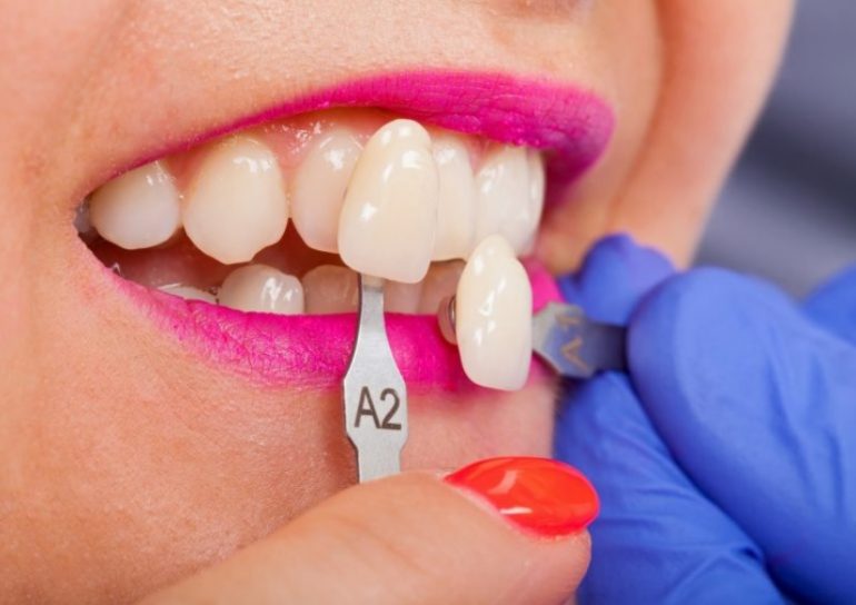 How Much Do Veneers Cost? | Sydney Dental Veneers