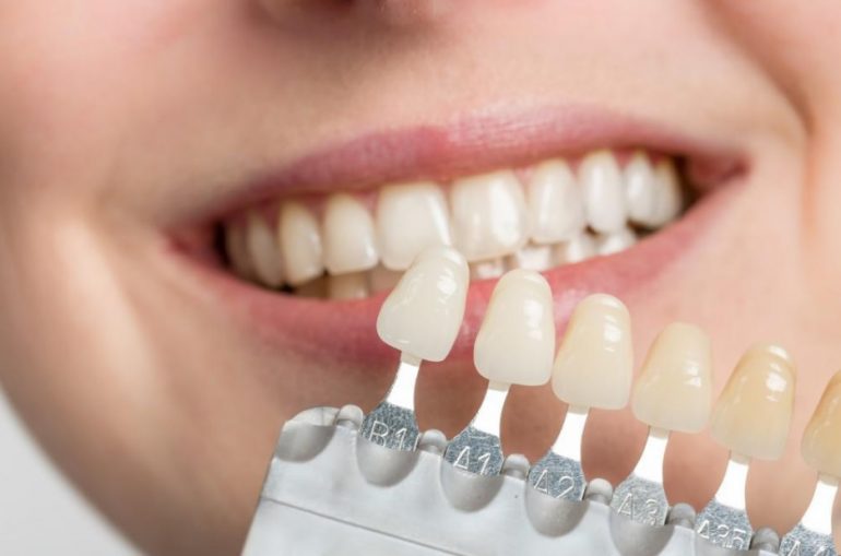 Veneers Price | Cost Of Veneers | Sydney Dental Veneers