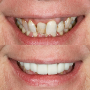 Porcelain Veneers