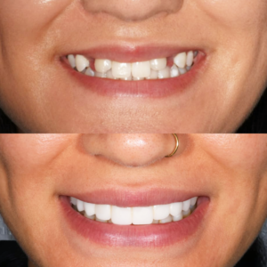 Porcelain Veneers