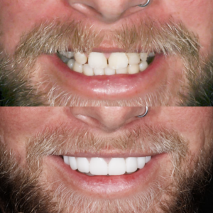 Porcelain Veneers