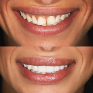 Porcelain Veneers