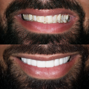 Porcelain Veneers