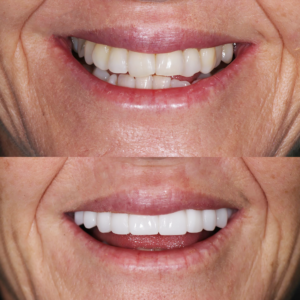 Porcelain Veneers