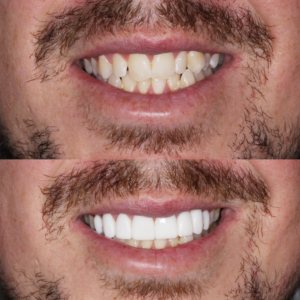 Porcelain Veneers