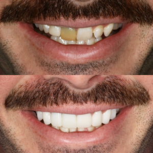 Porcelain Veneers