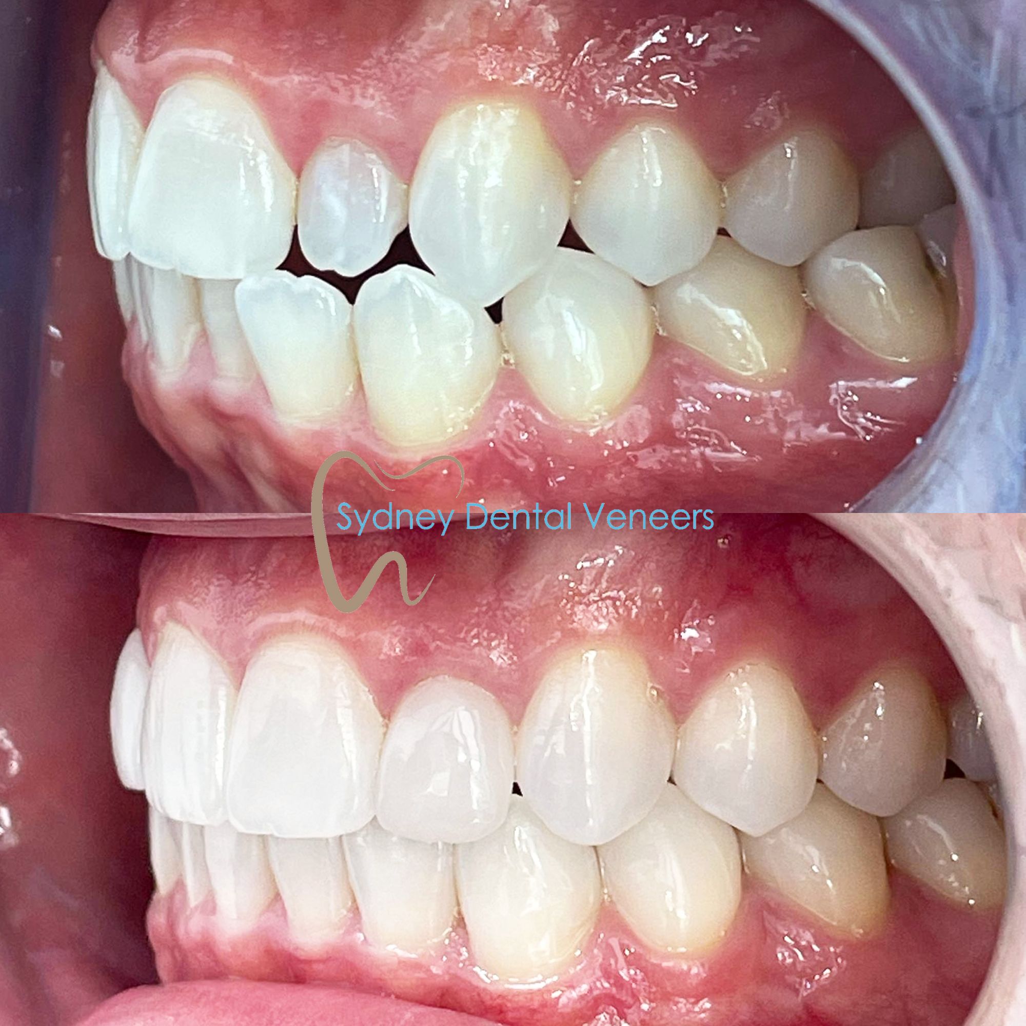 Invisalign Before and After Sydney