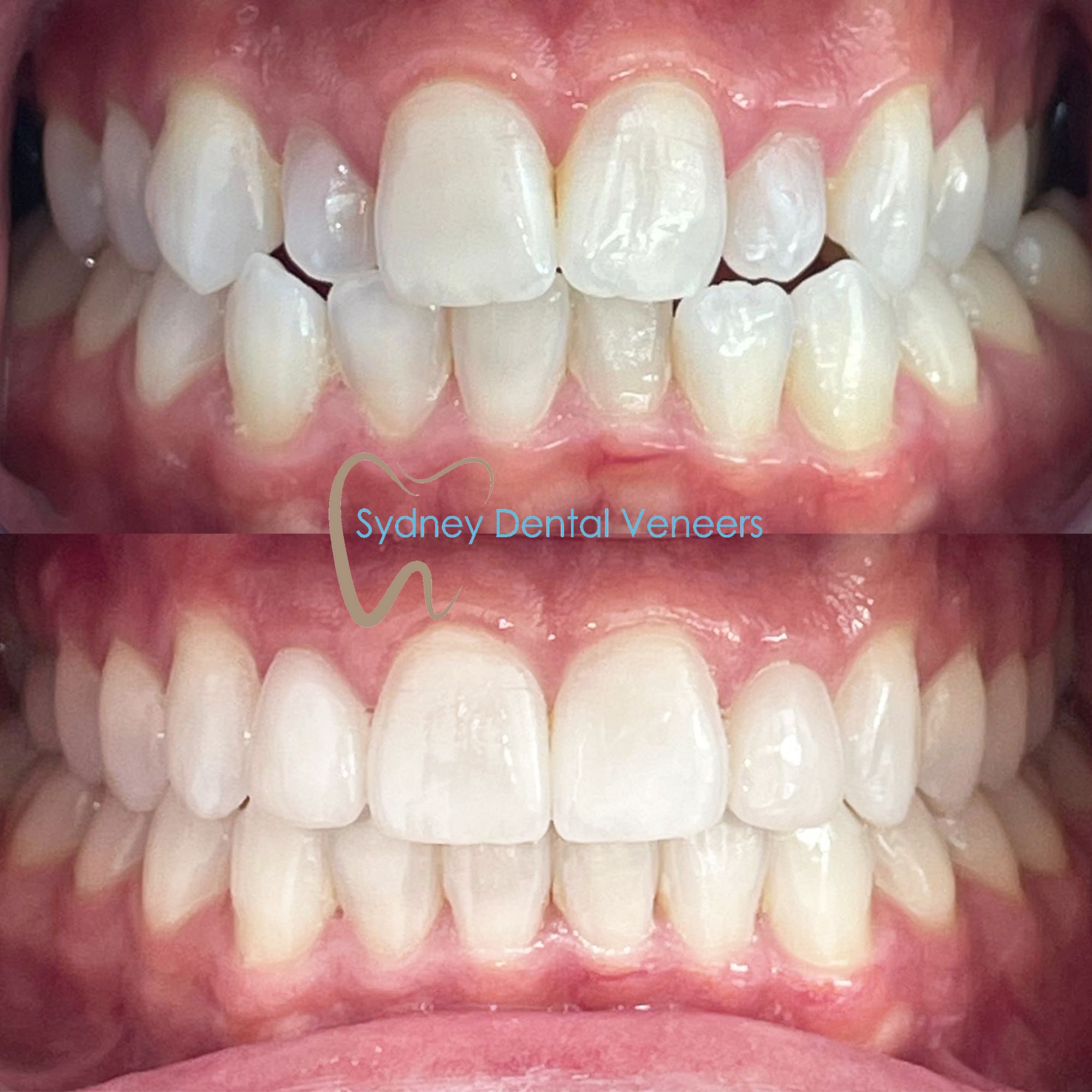 Invisalign Smile Transformation Sydney