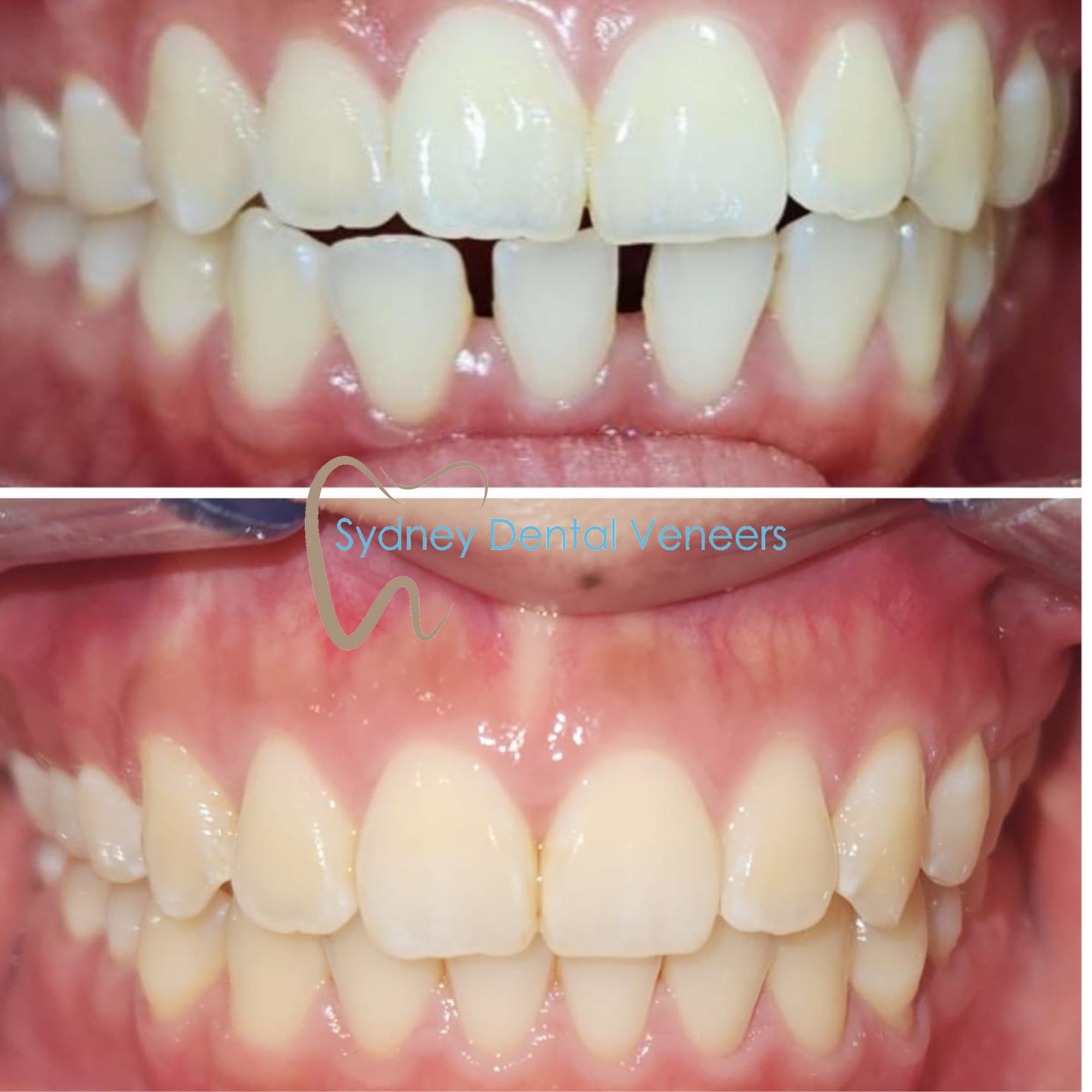 Invisalign Transformation Sydney